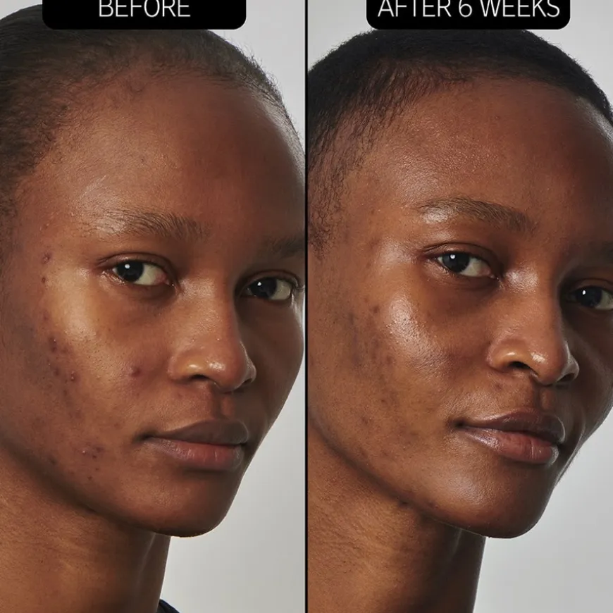 SuperSolutions 20% Niacinamide Serum